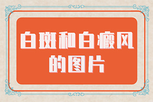 上顎白斑初期癥狀圖片(常見癥狀是什么樣的)