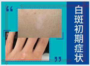 白風(fēng)癲早期癥狀圖,發(fā)生時(shí)的特點(diǎn)有(常見(jiàn)的癥狀會(huì)有哪些呢)