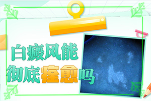 白癲風(fēng)初期癥狀圖片[怎么能看出長啥樣的]輕度白癩風(fēng)圖片早期