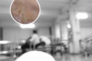 進(jìn)展期白殿風(fēng)（白斑吃了三個(gè)月的免疫力藥）